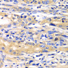 Immunohistochemistry of paraffin-embedded human gastric cancer using SARS antibody (14-938) at dilution of 1:100 (40x lens) .