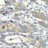 Immunohistochemistry of paraffin-embedded human gastric cancer using CHMP2B antibody (14-974) at dilution of 1:100 (40x lens) .