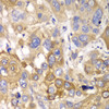 Immunohistochemistry of paraffin-embedded human esophageal cancer using PPP1CB antibody (15-047) at dilution of 1:100 (40x lens) .