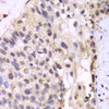 Immunohistochemistry of paraffin-embedded human lung cancer using PSMA6 antibody (15-051) at dilution of 1:100 (40x lens) .