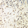 Immunohistochemistry of paraffin-embedded human kidney cancer using HAUSP / USP7 antibody (15-072) at dilution of 1:200 (40x lens) .