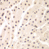 Immunohistochemistry of paraffin-embedded human liver cancer using UHRF2 antibody (15-099) at dilution of 1:200 (40x lens) .