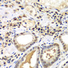 Immunohistochemistry of paraffin-embedded human gastric cancer using PSME2 antibody (15-112) at dilution of 1:100 (40x lens) .