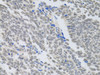 Immunohistochemistry of paraffin-embedded human lung cancer using PAX3 antibody (15-273) at dilution of 1:100 (40x lens) .