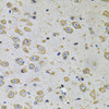 Immunohistochemistry of paraffin-embedded human gastric cancer using RhoA Antibody (15-286) at dilution of 1:100 (40x lens) .