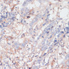 Immunohistochemistry of paraffin-embedded human colon carcinoma using ZNRF3 antibody (16-383) at dilution of 1:100 (40x lens) .