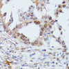 Immunohistochemistry of paraffin-embedded human lung cancer using IGHMBP2 antibody (16-402) at dilution of 1:100 (40x lens) .