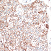 Immunohistochemistry of paraffin-embedded human liver cancer using SLAMF7 antibody (16-659) at dilution of 1:100 (40x lens) .