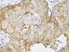 Immunohistochemistry of paraffin-embedded human breast cancer using PDE4D antibody (16-670) at dilution of 1:100 (40x lens) .