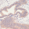 Immunohistochemistry of paraffin-embedded human mammary cancer using AMPK alpha 1 antibody (16-698) at dilution of 1:200 (40x lens) .