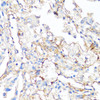 Immunohistochemistry of paraffin-embedded human lung cancer using Fibronectin antibody (16-709) at dilution of 1:100 (40x lens) .