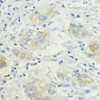 Immunohistochemistry of paraffin-embedded human liver cancer using SURF4 antibody (16-739) at dilution of 1:200 (40x lens) .