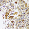 Immunohistochemistry of paraffin-embedded human uterine cancer using CAST antibody (16-749) at dilution of 1:100 (40x lens) .