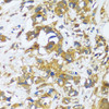 Immunohistochemistry of paraffin-embedded human breast cancer using CAST antibody (16-750) at dilution of 1:100 (40x lens) .