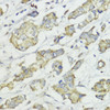 Immunohistochemistry of paraffin-embedded human mammary cancer using Cyclin B1 antibody (16-755) at dilution of 1:100 (40x lens) .