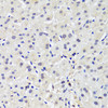 Immunohistochemistry of paraffin-embedded human liver cancer using DNMT1 antibody (16-768) at dilution of 1:200 (40x lens) .