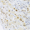 Immunohistochemistry of paraffin-embedded human liver cancer using HIF1A antibody (16-781) at dilution of 1:200 (40x lens) .