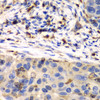 Immunohistochemistry of paraffin-embedded human esophageal cancer using S100A8 antibody (16-785) at dilution of 1:100 (40x lens) .