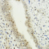Immunohistochemistry of paraffin-embedded human uterine cancer using LDB1 antibody (16-992) at dilution of 1:200 (40x lens) .