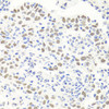 Immunohistochemistry of paraffin-embedded human esophageal cancer using EXO1 antibody (18-402) at dilution of 1:100 (40x lens) .