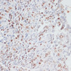 Immunohistochemistry of paraffin-embedded human lung cancer using Ki67 antibody (18-495) at dilution of 1:200 (40x lens) .