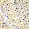 Immunohistochemistry of paraffin-embedded human lung cancer using NUP62 antibody (18-670) at dilution of 1:100 (40x lens) .