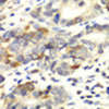 Immunohistochemistry of paraffin-embedded human colon carcinoma using APLP1 antibody (18-746) at dilution of 1:100 (40x lens) .