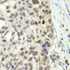 Immunohistochemistry of paraffin-embedded human esophageal cancer using E2F6 antibody (18-784) at dilution of 1:100 (40x lens) .