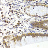 Immunohistochemistry of paraffin-embedded human gastric cancer using CDK6 Antibody (18-973) at dilution of 1:200 (40x lens) .