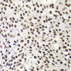 Immunohistochemistry of paraffin-embedded human lung cancer using NELFE antibody (19-008) at dilution of 1:100 (40x lens) .