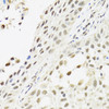 Immunohistochemistry of paraffin-embedded human lung cancer using C14orf166 antibody (19-068) at dilution of 1:100 (40x lens) .