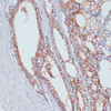 Immunohistochemistry of paraffin-embedded human colon carcinoma using SLC39A4 antibody (19-072) at dilution of 1:100 (40x lens) .