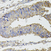 Immunohistochemistry of paraffin-embedded human colon carcinoma using UBE2S antibody (19-436) at dilution of 1:100 (40x lens) .