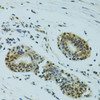 Immunohistochemistry of paraffin-embedded human breast cancer using NHEJ1 antibody (19-514) at dilution of 1:100 (40x lens) .