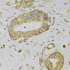 Immunohistochemistry of paraffin-embedded human liver cancer using EIF4B Antibody (19-645) at dilution of 1:100 (40x lens) .
