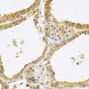 Immunohistochemistry of paraffin-embedded human thyroid cancer using FHL1 Antibody (19-678) at dilution of 1:100 (40x lens) .