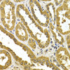 Immunohistochemistry of paraffin-embedded human kidney cancer using UGT1A4 antibody (19-725) at dilution of 1:200 (40x lens) .