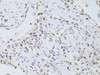 Immunohistochemistry of paraffin-embedded human gastric cancer using FKBP4 Antibody (19-774) at dilution of 1:100 (40x lens) .