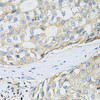 Immunohistochemistry of paraffin-embedded human breast cancer using CD98 antibody (19-804) at dilution of 1:100 (40x lens) .