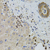 Immunohistochemistry of paraffin-embedded human liver damage using KTN1 antibody (19-913) at dilution of 1:100 (40x lens) .
