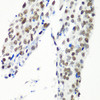 Immunohistochemistry of paraffin-embedded human lung cancer using HTATSF1 antibody (19-967) at dilution of 1:100 (40x lens) .