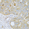 Immunohistochemistry of paraffin-embedded human colon carcinoma using PSG1 antibody (22-189) at dilution of 1:100 (40x lens) .