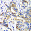 Immunohistochemistry of paraffin-embedded human liver cancer using RPL9 antibody (22-196) at dilution of 1:100 (40x lens) .