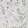 Immunohistochemistry of paraffin-embedded human breast cancer using UBE3C Antibody (22-225) at dilution of 1:100 (40x lens) .