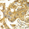 Immunohistochemistry of paraffin-embedded human liver cancer using CAPNS1 antibody (22-296) at dilution of 1:100 (40x lens) .