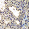 Immunohistochemistry of paraffin-embedded human oophoroma using CENPC antibody (22-310) at dilution of 1:200 (40x lens) .