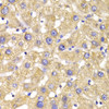 Immunohistochemistry of paraffin-embedded human liver damage using GPD2 Antibody (22-349) at dilution of 1:100 (40x lens) .