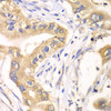 Immunohistochemistry of paraffin-embedded human liver cancer using HAGH antibody (22-353) at dilution of 1:100 (40x lens) .