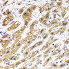 Immunohistochemistry of paraffin-embedded human liver cancer using HAPLN1 antibody (22-354) at dilution of 1:100 (40x lens) .