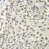 Immunohistochemistry of paraffin-embedded human well-differentiated squamous skin carcinoma using PUF60 antibody (22-425) at dilution of 1:100 (40x lens) .